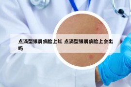 点滴型银屑病脸上红 点滴型银屑病脸上会出吗