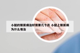 小腿的银屑病治好需要几个月 小腿上银屑病为什么难治