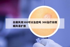 白癜风用308可以治愈吗 308治疗白斑癜风易扩散