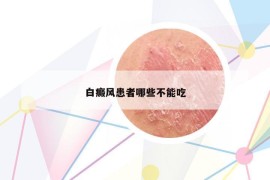 白癜风患者哪些不能吃