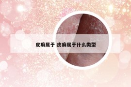 皮癣属于 皮癣属于什么类型