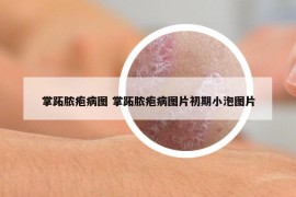 掌跖脓疱病图 掌跖脓疱病图片初期小泡图片