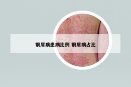 银屑病患病比例 银屑病占比