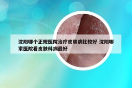 沈阳哪个正规医院治疗皮肤病比较好 沈阳哪家医院看皮肤科病最好