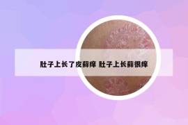 肚子上长了皮藓痒 肚子上长藓很痒