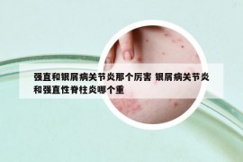 强直和银屑病关节炎那个厉害 银屑病关节炎和强直性脊柱炎哪个重