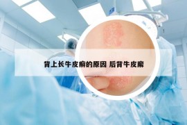 背上长牛皮癣的原因 后背牛皮廨