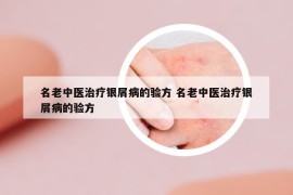 名老中医治疗银屑病的验方 名老中医治疗银屑病的验方