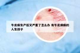 牛皮癣生产后又严重了怎么办 有牛皮病癣的人生孩子