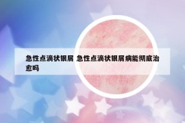 急性点滴状银屑 急性点滴状银屑病能彻底治愈吗