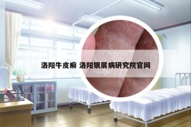 洛阳牛皮癣 洛阳银屑病研究院官网