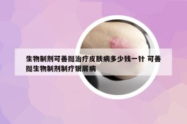 生物制剂可善挺治疗皮肤病多少钱一针 可善挺生物制剂制疗银屑病