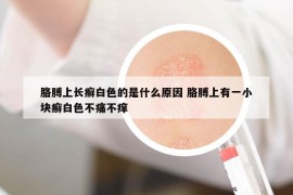 胳膊上长癣白色的是什么原因 胳膊上有一小块癣白色不痛不痒