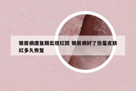 银屑病康复期出现红斑 银屑病好了但是皮肤红多久恢复