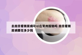 去南京看银屑病可以在常州报销吗 南京看银屑病要花多少钱