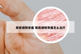 银屑病锁骨痛 银屑病锁骨痛怎么治疗