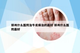 郑州什么医院治牛皮癣治的最好 郑州什么医院最好