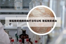 掌跖银屑病用放血疗法可以吗 掌跖银屑病治疗