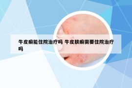 牛皮癣能住院治疗吗 牛皮肤癣需要住院治疗吗