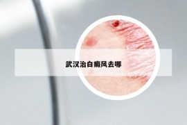 武汉治白癜风去哪