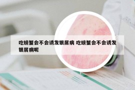 吃螃蟹会不会诱发银屑病 吃螃蟹会不会诱发银屑病呢