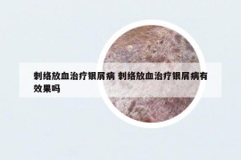 刺络放血治疗银屑病 刺络放血治疗银屑病有效果吗