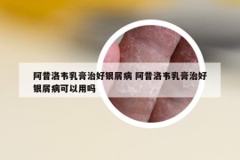 阿昔洛韦乳膏治好银屑病 阿昔洛韦乳膏治好银屑病可以用吗