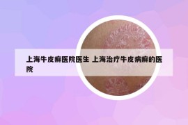 上海牛皮癣医院医生 上海治疗牛皮病癣的医院