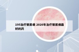 195治疗银屑病 2020年治疗银屑病最好的药