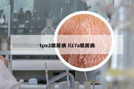 tpx2银屑病 il17a银屑病