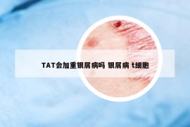 TAT会加重银屑病吗 银屑病 t细胞