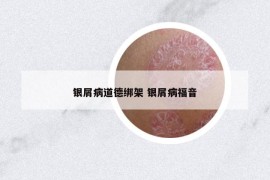 银屑病道德绑架 银屑病福音