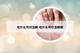 吃什么可以治癣 吃什么可以治癣病