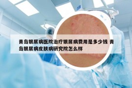 青岛银屑病医院治疗银屑病费用是多少钱 青岛银屑病皮肤病研究院怎么样