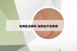 蚯蚓能治癣吗 蚯蚓治疗皮肤病