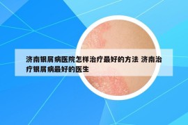 济南银屑病医院怎样治疗最好的方法 济南治疗银屑病最好的医生