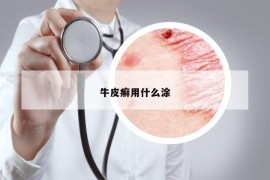 牛皮癣用什么涂