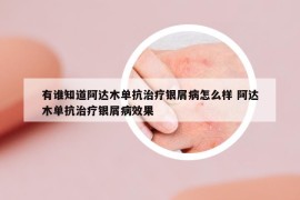 有谁知道阿达木单抗治疗银屑病怎么样 阿达木单抗治疗银屑病效果