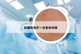 白癜风光疗一次多长时间