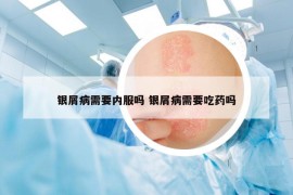 银屑病需要内服吗 银屑病需要吃药吗