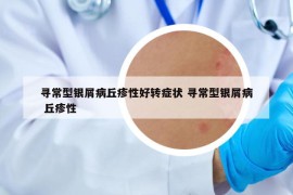 寻常型银屑病丘疹性好转症状 寻常型银屑病 丘疹性