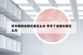 怀孕期间皮肤长癣怎么办 怀孕了皮肤长癣怎么办