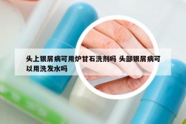 头上银屑病可用炉甘石洗剂吗 头部银屑病可以用洗发水吗