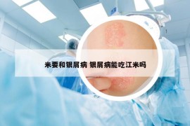 米要和银屑病 银屑病能吃江米吗