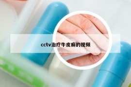 cctv治疗牛皮癣的视频