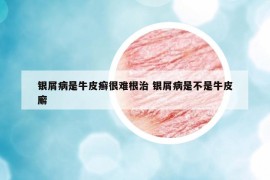 银屑病是牛皮癣很难根治 银屑病是不是牛皮廨