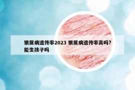 银屑病遗传率2023 银屑病遗传率高吗?能生孩子吗