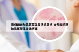 当归四逆加吴茱萸生姜汤银屑病 当归四逆汤加吴茱萸生姜汤医案