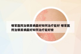 哪家医院治银屑病最好如何治疗能好 哪家医院治银屑病最好如何治疗能好些