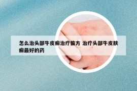 怎么治头部牛皮癣治疗偏方 治疗头部牛皮肤癣最好的药